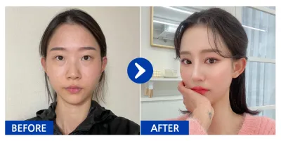 [Babytalk] Phẫu thuật lại mắt, tái sắp xếp mỡ dưới mắt, nâng mũi, phẫu thuật đường nét khuôn mặt 2 vùng (gò má, xương hàm), nâng ngực (Motiva), cấy mỡ (trán, má trước) / Tháng thứ 3 / Biệt danh: Dyudyudyujyujyu