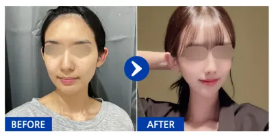 [Gangnam Unni] Phẫu thuật gọt mặt 2 vùng (hàm vuông, gò má) tháng thứ 1 / Biệt danh: Tuyulyi