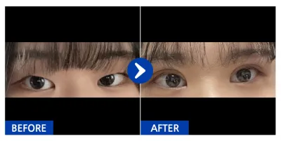 [Gangnam Unni] Cắt mí (rạch), chỉnh hình mắt tháng thứ 1 / Biệt danh: Yong-jjeo-gu