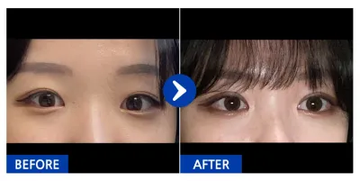 [Gangnam Unni] Cắt mí tháng thứ 1 / Biệt danh: Petit Woong-deong