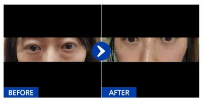 [Gangnam Unni] Tái cấu trúc mỡ dưới mắt, cấy mỡ má trước tháng thứ 1 / Biệt danh: Rarararang-in