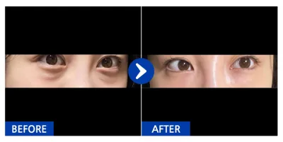 [Gangnam Unni] Tái định vị mỡ dưới mắt ngày thứ 7 / Biệt danh: Dongjigeumji