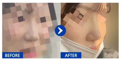 [Gangnam Unni] Nâng mũi tháng thứ 1 / Biệt danh: luckyyeji