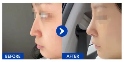 [Gangnam Unni] Nâng mũi tuần 1 / Biệt danh: Ppyuing-pping