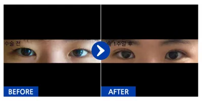 [Gangnam Unni] Nhấn mí (phương pháp luồn chỉ) Tuần 1 / Biệt danh: Dudutada