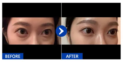 [Gangnam Unni] Tái định vị mỡ dưới mắt tháng thứ 1_liina_