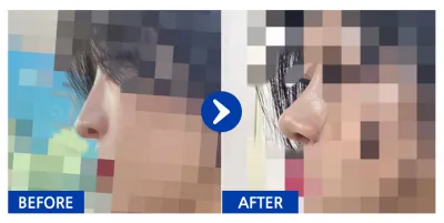 [Gangnam Unni] Nâng mũi tháng thứ 1_aaaa1212