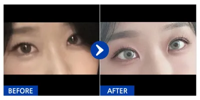 [Gangnam Unni] Tái định vị mỡ mí mắt dưới / Sau 1 tháng / Biệt danh: hyupp_p