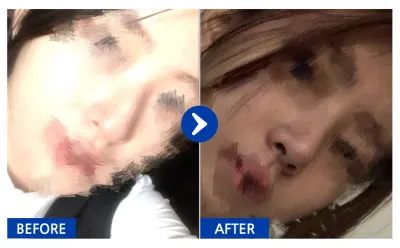 [Babitalk] Nâng mũi tháng thứ 1 / Biệt danh: 냥이gRtzK_K