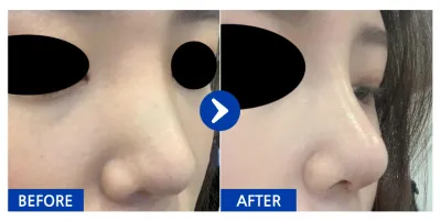 [Babytalk] Phẫu thuật nâng mũi tháng thứ 1 / Biệt danh: Yung-i-na