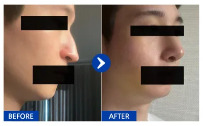 [Babitalk] Phẫu thuật nâng mũi sau 1 tháng / Biệt danh: 여우9Kcqw