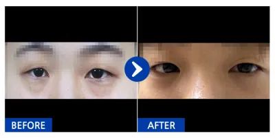 [Gangnam Unni] Tái định vị mỡ dưới mắt / 1 tháng / Biệt danh: yykkyyk