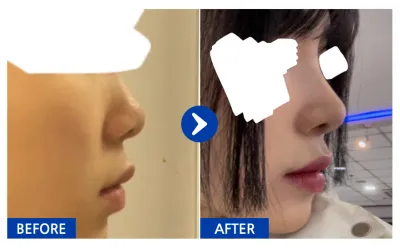 [Babytalk] Nâng mũi tháng thứ 1 / Biệt danh: Kokomon