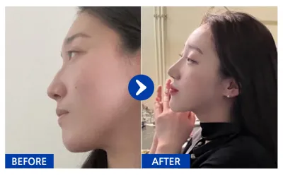 [Babitalk] 1 năm sau phẫu thuật nâng mũi / Biệt danh: atmospe