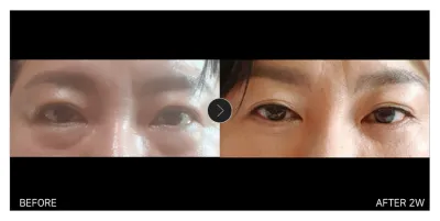 [Review Gangnam Unni] Cắt mí dưới + Căng chỉ tuần thứ 2 / Biệt danh: Ganishini