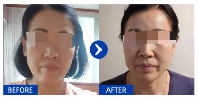 [Babytalk] Căng chỉ tháng thứ 1 / Biệt danh: Nyangi b6sKx