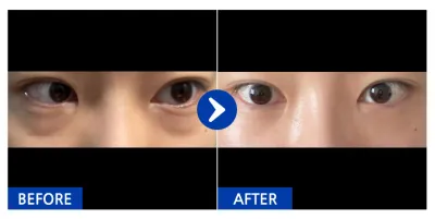 [Gangnam Unni] Tái cấu trúc mỡ dưới mắt / Tháng thứ 1 / Biệt danh: castle030