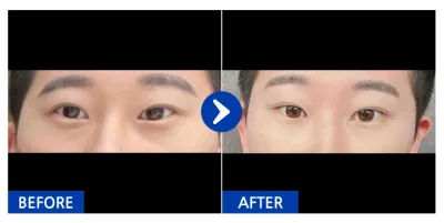 [Gangnam Unni] Tái cấu trúc mỡ bọng mắt / Tháng thứ 1 / Biệt danh: Jjangjjang59