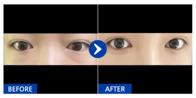 [Gangnam Unni] Tái định vị mỡ dưới mắt / Sau 1 tháng / Biệt danh: Ha-it-eo