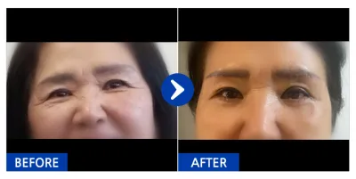 [Gangnam Unni] Nâng cung chân mày, cắt mí dưới / Sau 1 tháng / Biệt danh: Jamsil Jane