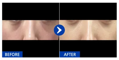 [Gangnam Unni] Tái cấu trúc mỡ dưới mắt / Tháng thứ 1 / Biệt danh: Ramen Gimbap Tteokbokki