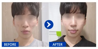 [Gangnam Unni] Hàm vuông, gò má, mũi / Tháng thứ 1 / Biệt danh: chgvv