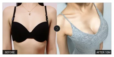 [Review Gangnam Unni] Phẫu thuật nâng ngực tháng thứ 10 / Biệt danh: Geumaaaan