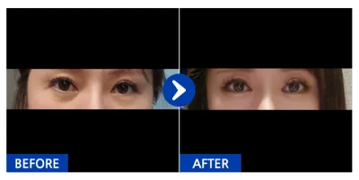 [Gangnam Unni] Cấy mỡ dưới mắt / Tuần 3 / Biệt danh: Cứ để tự nhiên~