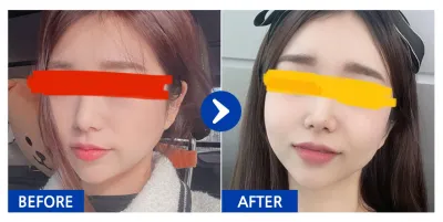 [Babitalk] Cấy mỡ toàn mặt / Tháng thứ 1 / Biệt danh: Juyubi