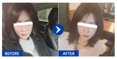 [Babitalk] Cấy mỡ toàn mặt, căng chỉ / Tuần 2 / Biệt danh: 갱쥐zXzo