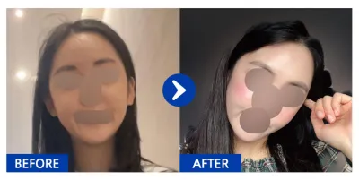 [Gangnam Unni] Cấy mỡ tự thân toàn mặt / Sau 1 tháng / Biệt danh: Cùng xinh đẹp lên nào