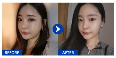 [Gangnam Unni] Hút mỡ mặt / Sau 1 tháng / Biệt danh: Gamjamojjing