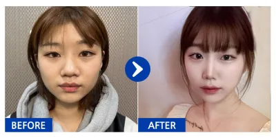 [Review Gangnam Unni] Nâng mũi / Tháng thứ 3 / Biệt danh: Ungnangnan