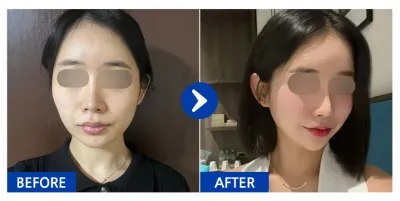 [Review Gangnam Unni] Combo 3 vùng xương mặt (gò má, cằm, hàm), ngực (Mentor Smooth) / Tháng thứ 3 / Biệt danh: 크루루루삥뽕