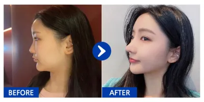 [Review Gangnam Unni] Phẫu thuật nâng mũi / Tháng thứ 1 / Biệt danh: Ning-i-ku-ku-dang