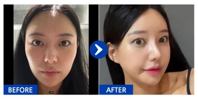 [Review Gangnam Unni] Phẫu thuật gọt mặt 3 vùng (gò má, cằm, hàm), nâng mũi / Tuần thứ 3 / Biệt danh: Park Tten-tten