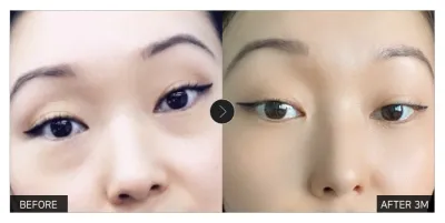 [Review Gangnam Unni] Tái cấu trúc mỡ mí mắt dưới tháng thứ 3 / Biệt danh: Mắt to vua ếch