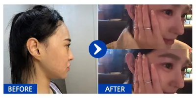 [Review Gangnam Unni] Phẫu thuật lại mũi / Tuần thứ 3 / Biệt danh: Hairuikba