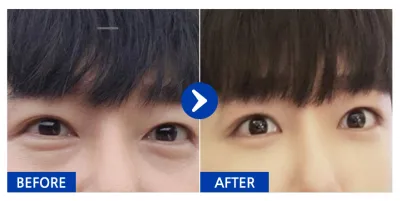 [Gangnam Unni] Tái định vị mỡ bọng mắt tháng thứ 1 / Biệt danh: Chris-eu