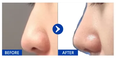 [Gangnam Unni] Mũi / Tháng thứ 1 / Biệt danh: nacola_