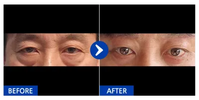 [Gangnam Unni] Cắt mí dưới, nâng cung chân mày / Sau 1 tháng / Biệt danh: B-J-Tti