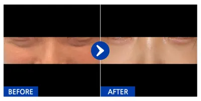 [Gangnam Unni] Tái định vị mỡ mí mắt dưới tháng thứ 1 / Biệt danh: Miㅣmimimiㅣ