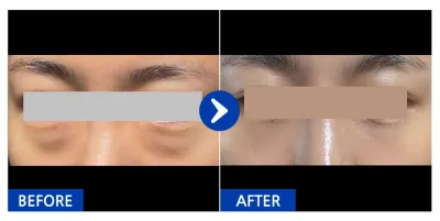 [Gangnam Unni] Tái sắp xếp mỡ dưới mắt / Tháng thứ 1 / Biệt danh: Ppu-eng-e-u