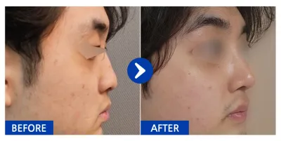 [Gangnam Unni] Nâng mũi / Sau 1 tháng / Biệt danh: Người yêu xoài khô