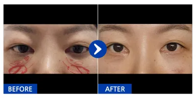 [Gangnam Unni] Tái định vị mỡ mí dưới / Sau 1 tháng / Nickname: Yurial76