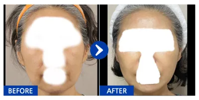 [Gangnam Unni] Phẫu thuật căng da mặt / Tháng thứ 1 / Biệt danh: Annyeong Unningning