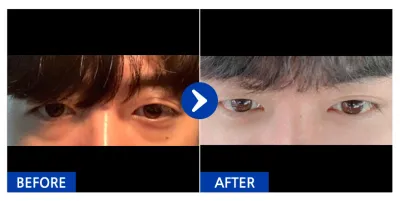 [Gangnam Unni] Tái cấu trúc mỡ dưới mắt / Tháng thứ 1 / Biệt danh: Kim Dong-woon