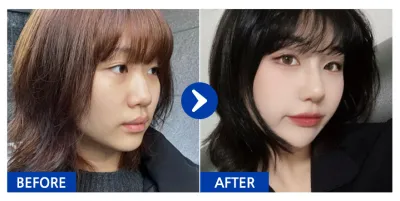 [Review Babitalk] Phẫu thuật nâng mũi / Tuần 1 / Biệt danh: Nananananan-ni