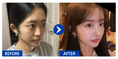 [Review của mình trên Gangnam Unni] Phẫu thuật nâng mũi, cấy mỡ trán / Tuần 1 / Biệt danh: Nyang Nyang Nyang Ung Ung