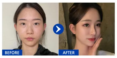 [Review Babitalk] Tái phẫu thuật mắt, mũi, ngực (Motiva), cấy mỡ (trán, gò má trước), thẩm mỹ đường nét khuôn mặt 2 vùng / 6 tháng / Biệt danh: DyuDyuDyuJyuJyu